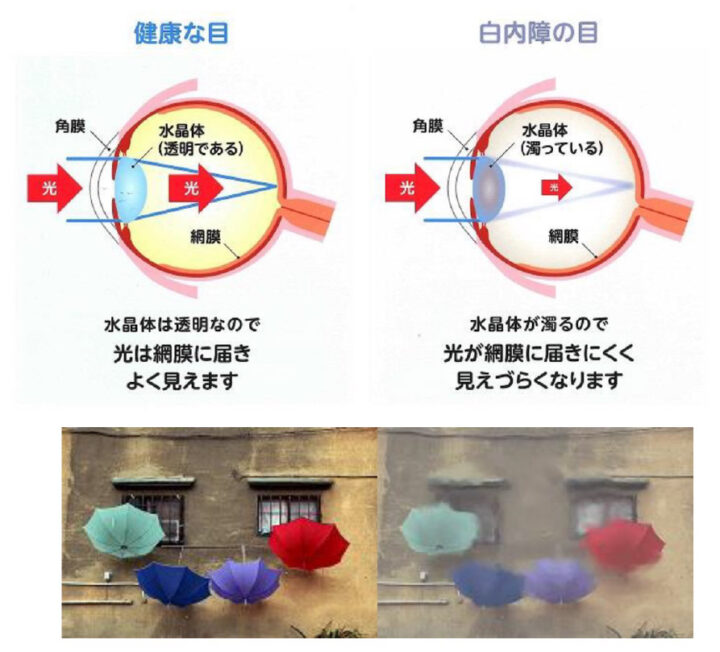 白内障のイメージ図
