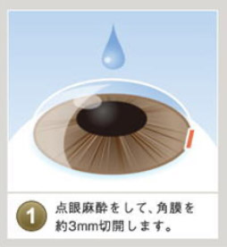 &nbsp;点眼麻酔を施して、角膜を約3mm切開します
