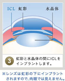 <strong>虹彩と水晶体の間にICLを埋め込みます</strong>