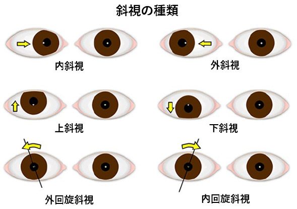 斜視の症状