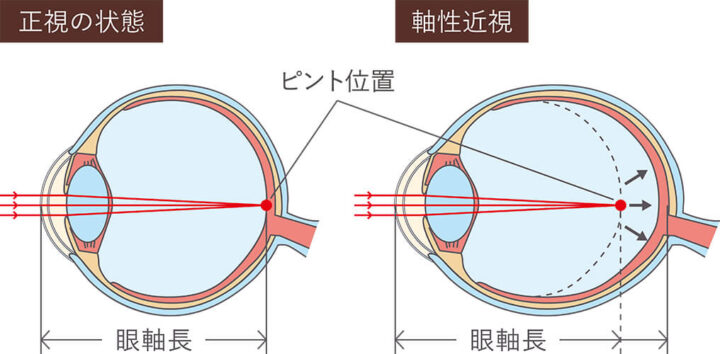 小児の近視抑制治療